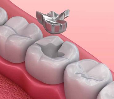 Trám răng xong thấy đau buốt nhức thì có bình thường không?