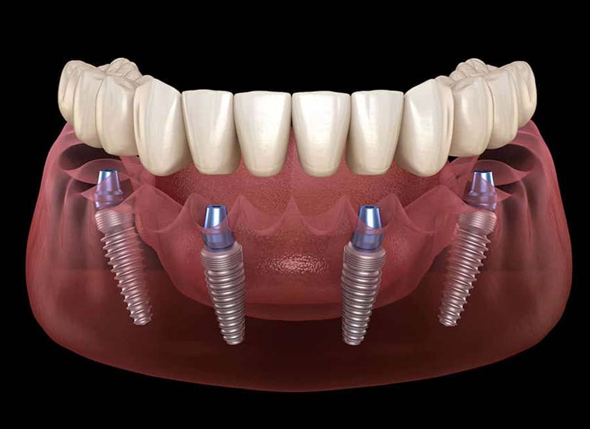 Cầu răng cấy ghép cố định toàn hàm — thường được gọi là All-on-4.