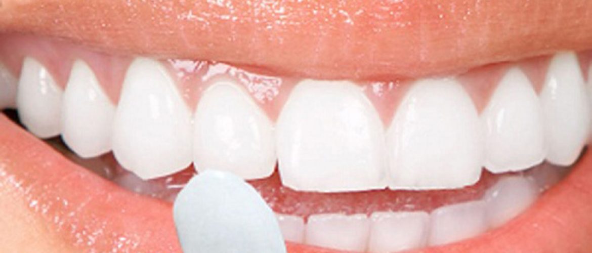 Bọc răng sứ là gì? Có nên bọc răng sứ không?