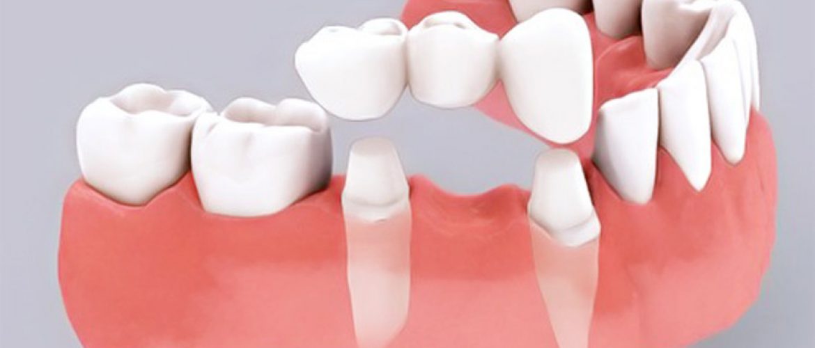 Quy trình làm cầu răng sứ chuẩn y khoa