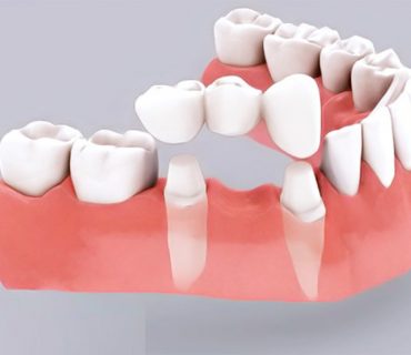 Quy trình làm cầu răng sứ chuẩn y khoa