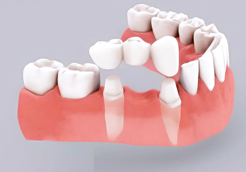 Cầu răng sứ là gì? Chọn loại cầu răng sứ phù hợp