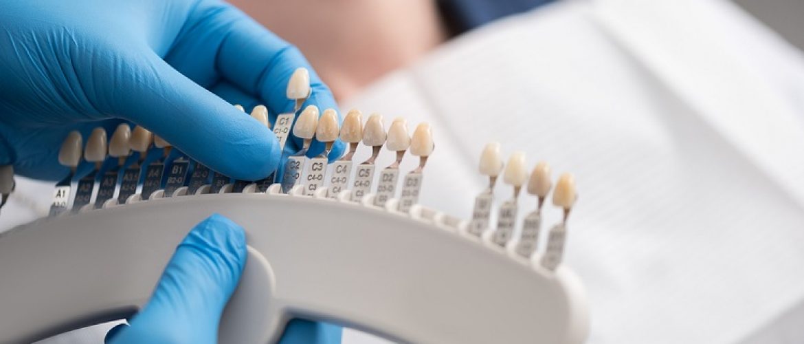 Những điều bạn cần biết về quy trình bọc răng sứ