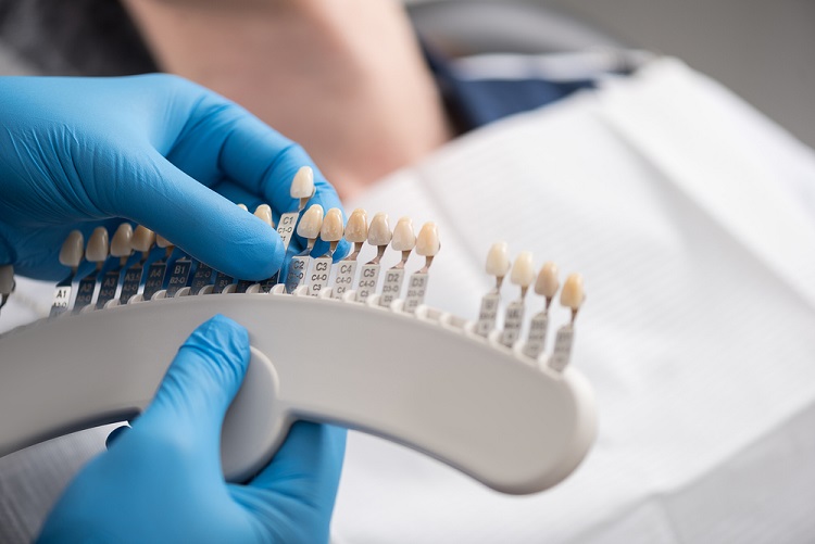 Những điều bạn cần biết về quy trình bọc răng sứ