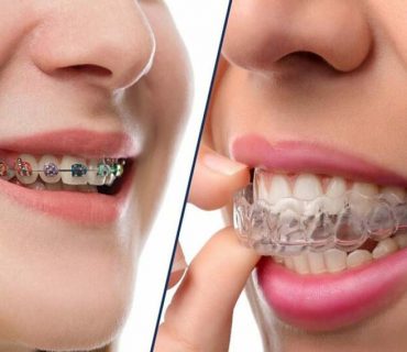 11 điều bạn nên biết trước khi niềng răng trong suốt