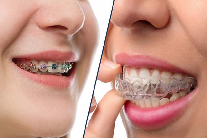 11 điều bạn nên biết trước khi niềng răng trong suốt