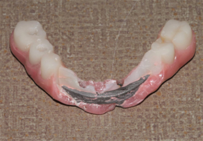 Gãy răng của phục hình All On 4 hoặc tiêu xương.