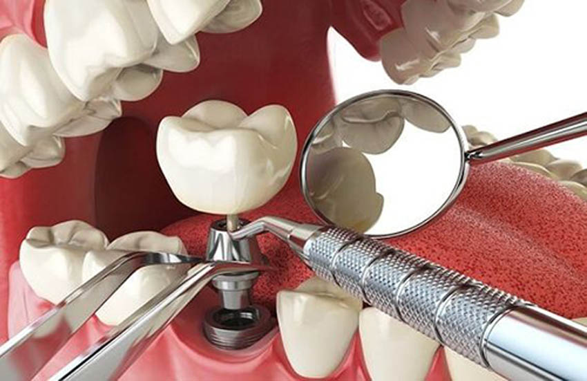 Tìm hiểu về quy trình cấy ghép răng implant