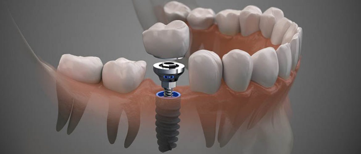 Quá trình trồng răng implant mất bao lâu?