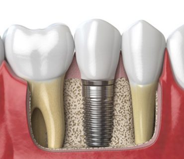 Cấy ghép răng implant – Phương pháp phục hồi răng hiệu quả