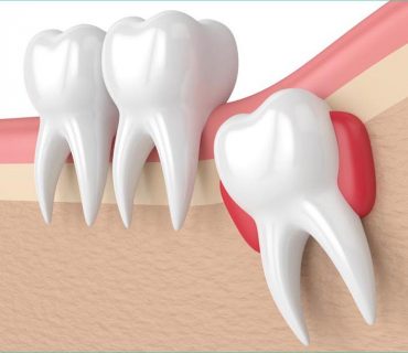 Mọc răng khôn đau trong bao lâu? Khi nào nên nhổ răng khôn?