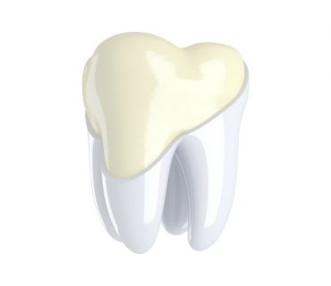 Mòn men răng là gì? Cách khắc phục mòn men răng