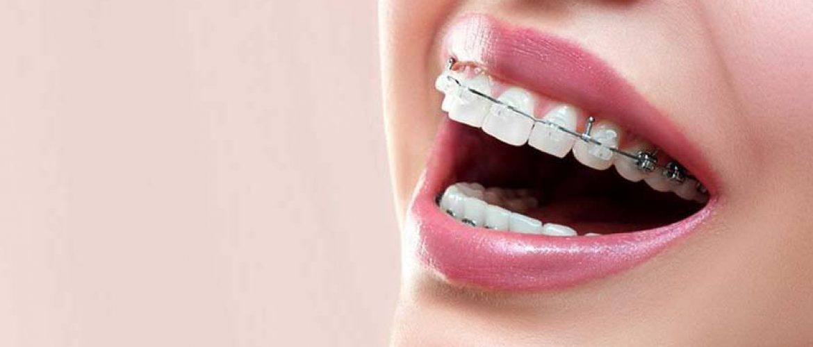 Chi phí của các loại niềng răng trên thị trường