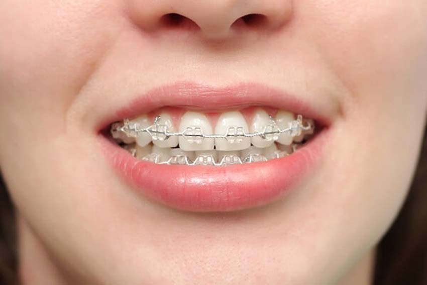 Niềng răng có đau không? Tìm hiểu quy trình niềng răng tại Hải Dental Clinic