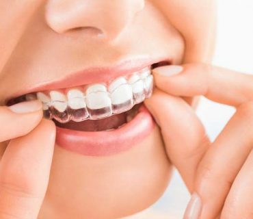 Niềng răng không mắc cài có ưu điểm gì?