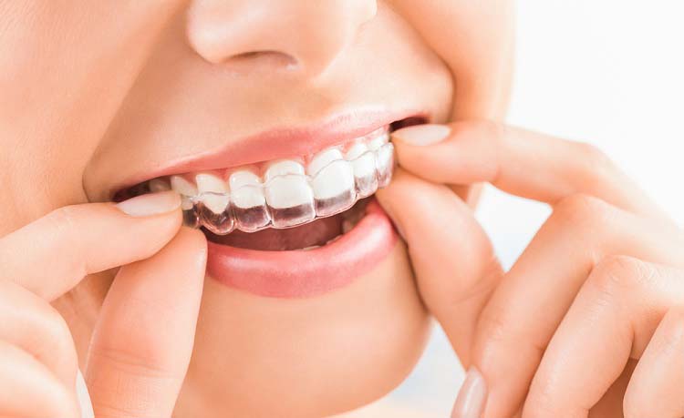 Niềng răng không mắc cài có ưu điểm gì?