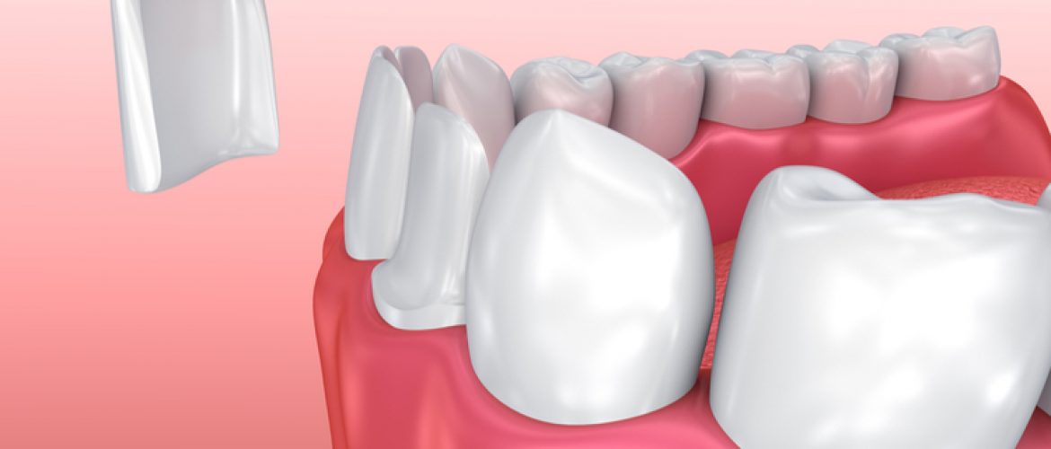 5 loại răng sứ thẩm mỹ phổ biến trên thị trường