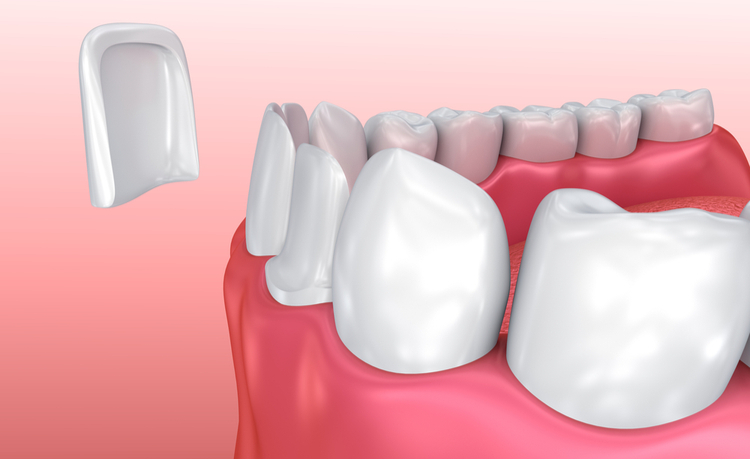 5 loại răng sứ thẩm mỹ phổ biến trên thị trường