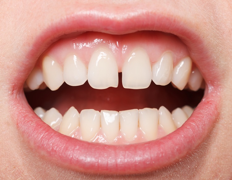 Bọc răng sứ có đau không? Ai nên bọc răng sứ?