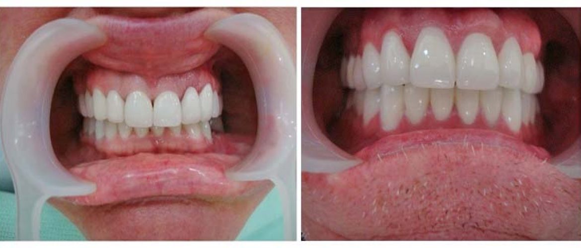 So sánh hai phương pháp bọc răng sứ và dán sứ veneer
