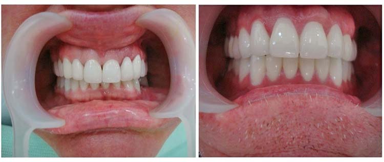 So sánh hai phương pháp bọc răng sứ và dán sứ veneer