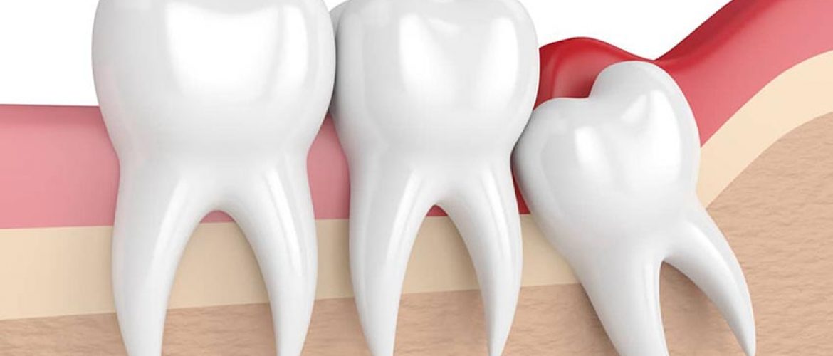 Răng khôn mọc lệch có nguy hiểm không? Có nên nhổ răng khôn mọc lệch?