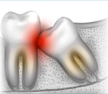 Sưng nướu răng răng khôn: Nguyên nhân, triệu chứng và cách điều trị