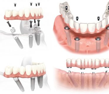 Quy trình trồng răng Implant All-on-4 cho người mất răng toàn hàm