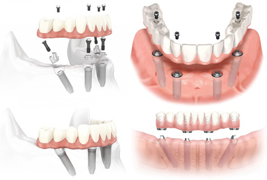 Quy trình trồng răng Implant All-on-4 cho người mất răng toàn hàm