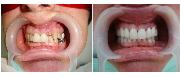 Hình ảnh trước và sau khi bọc răng sứ.