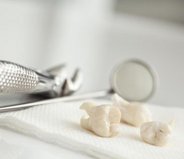 Vì sao cần nhổ răng khôn? Nhổ răng khôn có nguy hiểm không?