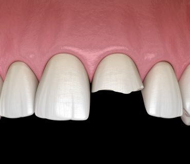 Phương pháp điều trị hiệu quả khi bị gãy răng