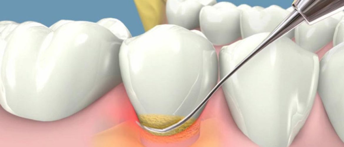 Cạo vôi răng có đau không? Có gây hại men răng không?