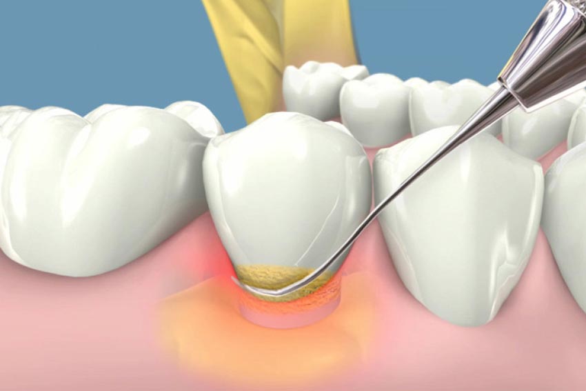 Cạo vôi răng có đau không? Có gây hại men răng không?