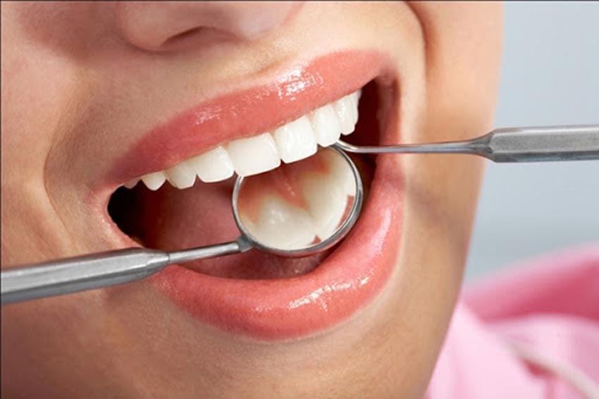 Cạo vôi răng có làm hại men răng không?