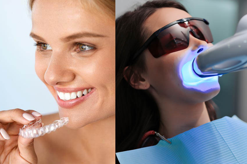 Khác biệt giữa tẩy trắng răng bằng laser với máng tẩy trắng răng chuyên nghiệp