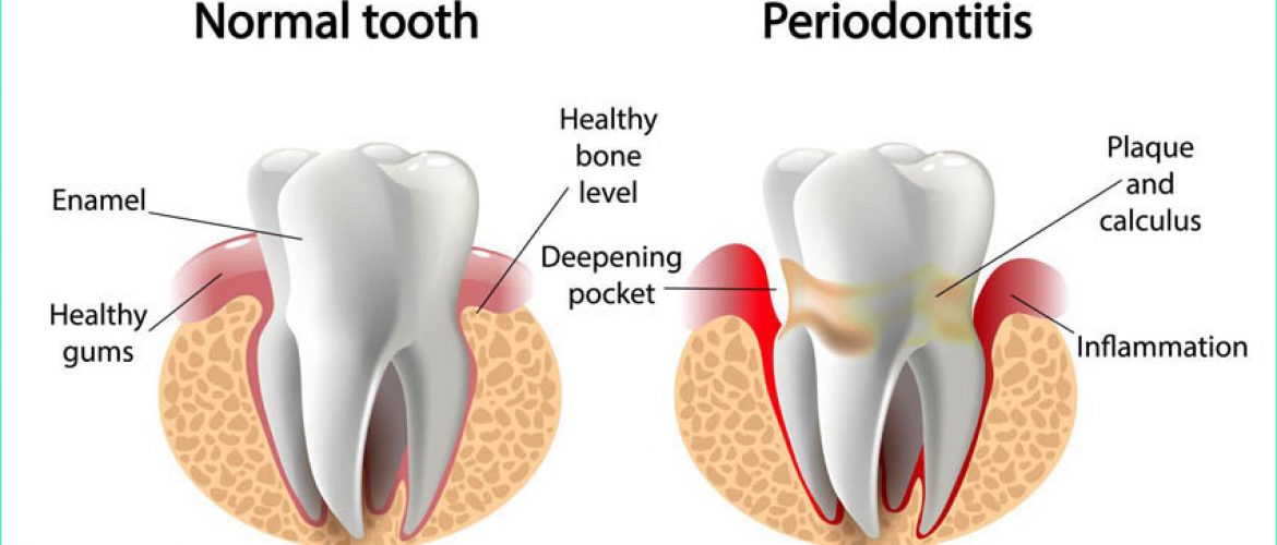 Viêm chân răng: Nguyên nhân và cách điều trị
