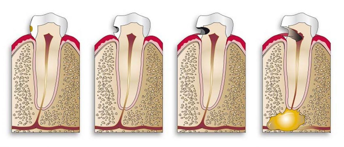 Sâu răng hàm: nguyên nhân và cách phòng ngừa