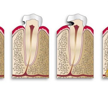 Sâu răng hàm: nguyên nhân và cách phòng ngừa