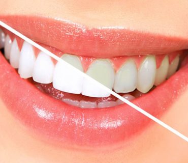 7 cách giảm ê buốt sau khi tẩy trắng răng