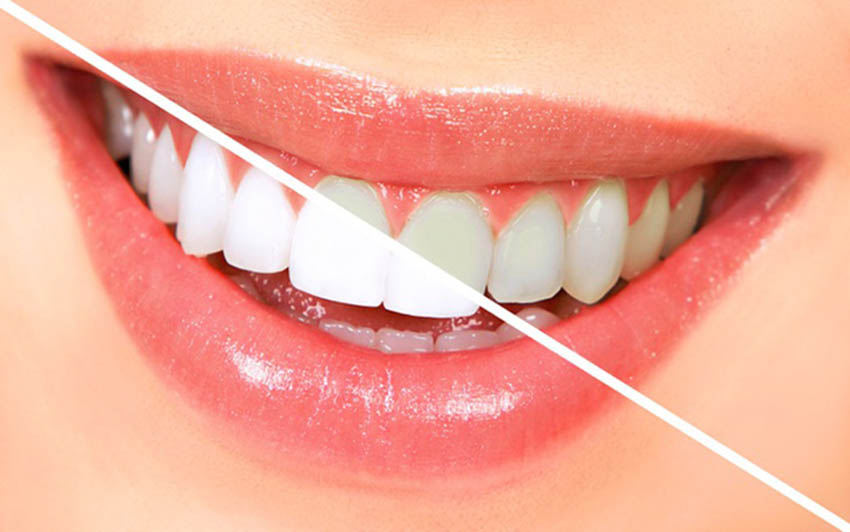 7 cách giảm ê buốt sau khi tẩy trắng răng
