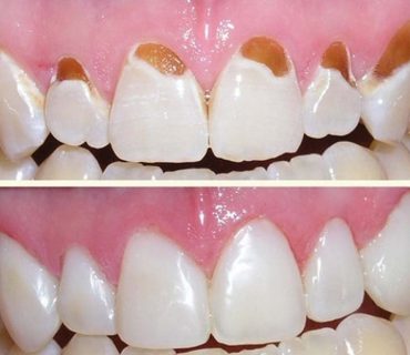 Những ưu điểm khi trám răng thẩm mỹ bằng composite