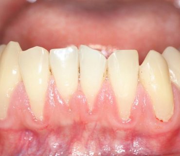 Tìm hiểu về tụt nướu chân răng, nguyên nhân và hướng điều trị