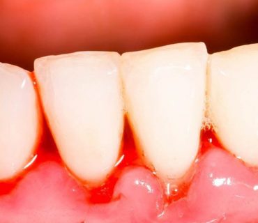 10 cách chữa chảy máu chân răng hiệu quả