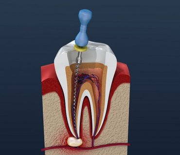 Viêm tủy răng là gì? Triệu chứng và điều trị