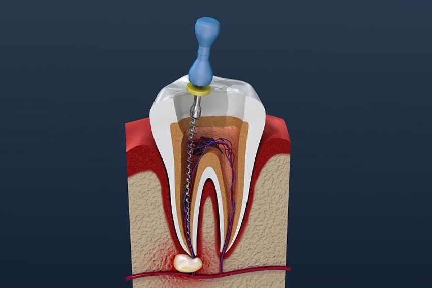 Viêm tủy răng là gì? Triệu chứng và điều trị