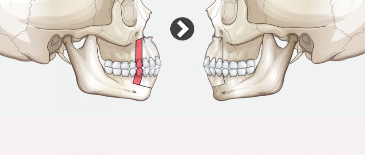 Phẫu thuật hàm hô không cần niềng răng – Wassmund and Koler Surgery
