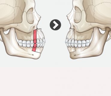 Phẫu thuật hàm hô không cần niềng răng – Wassmund and Koler Surgery