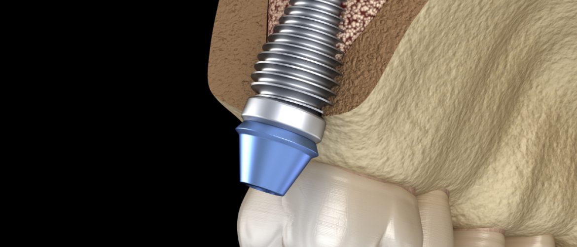 Nâng xoang trong cấy ghép Implant là gì? Kín và Hở khác gì nhau?