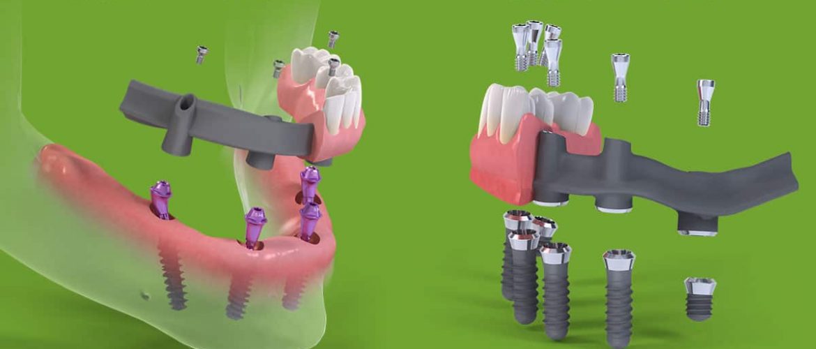 Quy trình Cấy ghép Implant All-on-4, 6 cho người mất răng toàn hàm